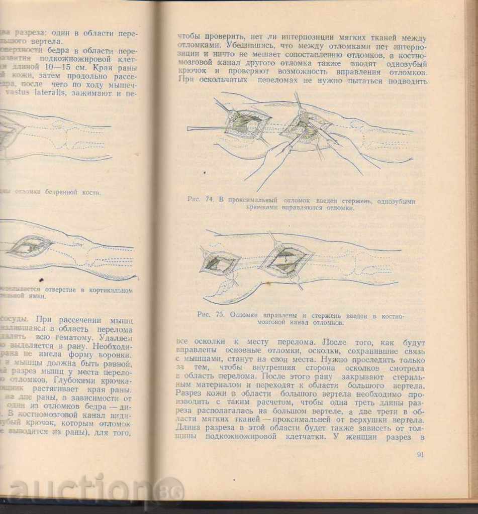 Auction Внутрикостная фиксация перелома хидрата Auction Внутрикостная фиксация перелома хидрата