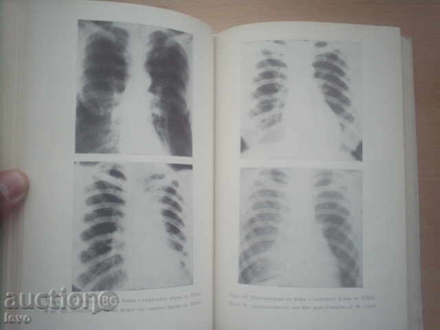 EMFIZEM PULMONAR-prof. Petăr Dobrev - 6