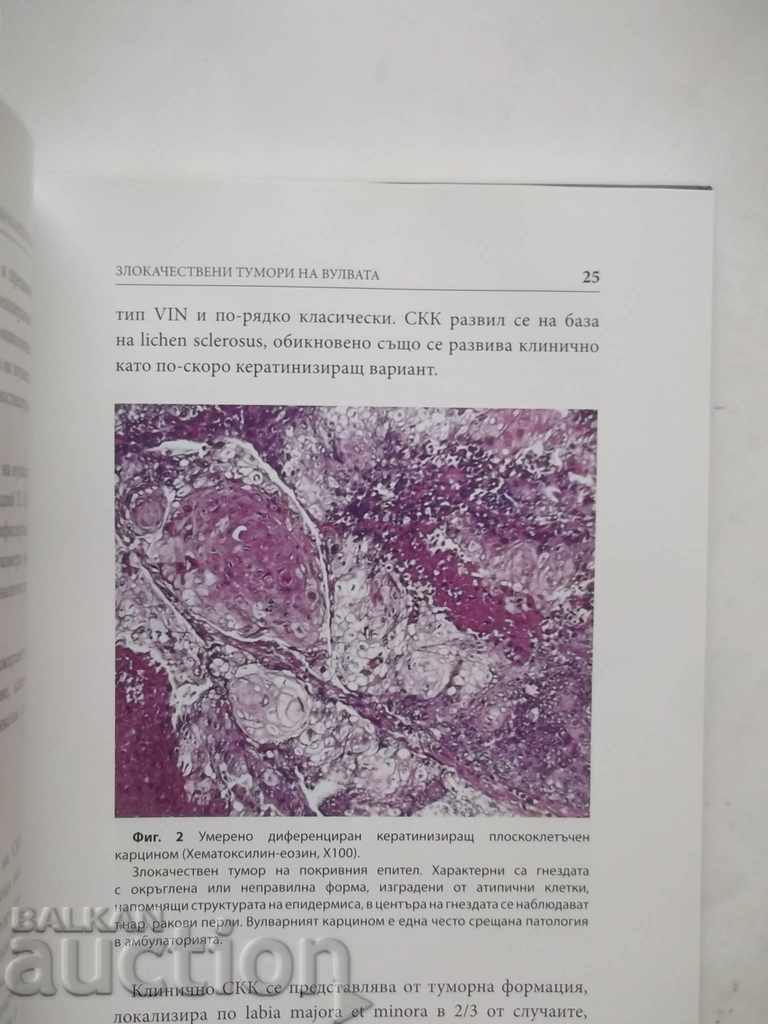 Malignant tumors of the vulva - Georgi Chernev and others. 2015 with price 27.00 BGN | € 13.80 Malignant tumors of the vulva - Georgi Chernev and others. 2015 with price 27.00 BGN | € 13.80