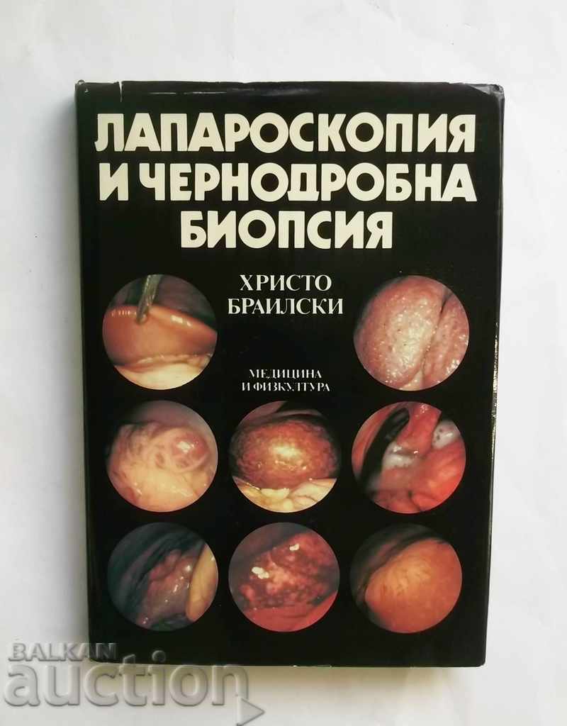 Лапароскопия и чернодробна биопсия - Христо Браилски 1989 г.