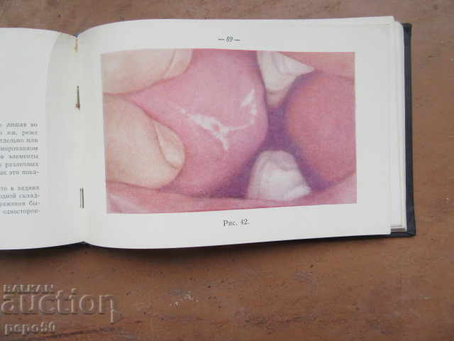 Diseases of the mucous membrane of the mouth-1960 - 7 Diseases of the mucous membrane of the mouth-1960 - 7