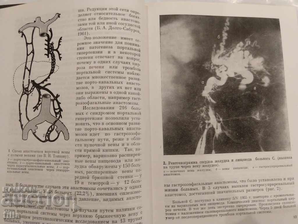 Medicine, Surgery for portal hypertension - 5 Medicine, Surgery for portal hypertension - 5