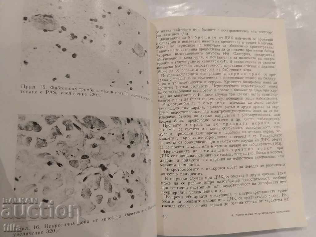 Medicine, Disseminated intravascular coagulation - 5 Medicine, Disseminated intravascular coagulation - 5