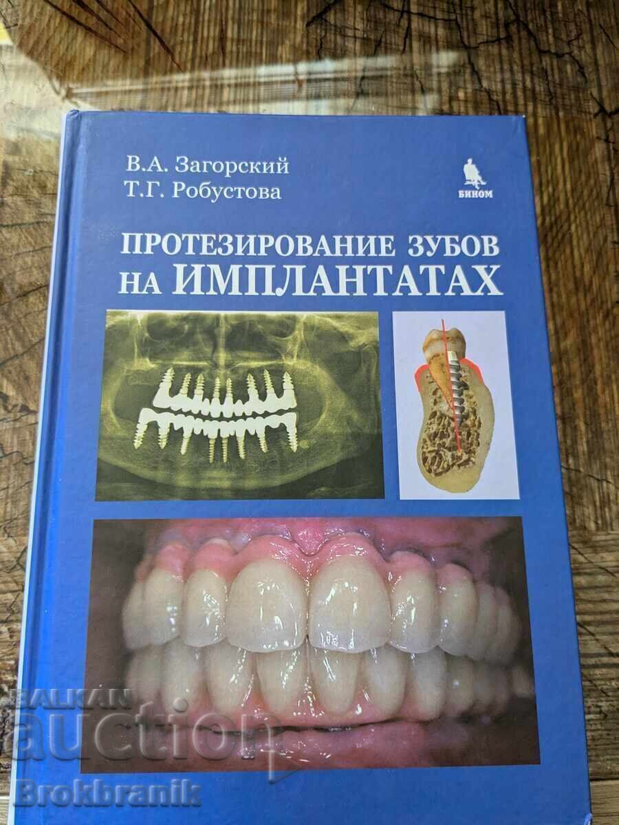 Protezare dentară pe implanturi