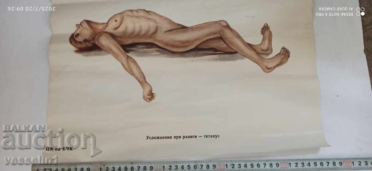 Old educational poster from the Bulgarian Red Cross - complications from wounds - with tetanus with price 18.00 BGN | € 9.20
