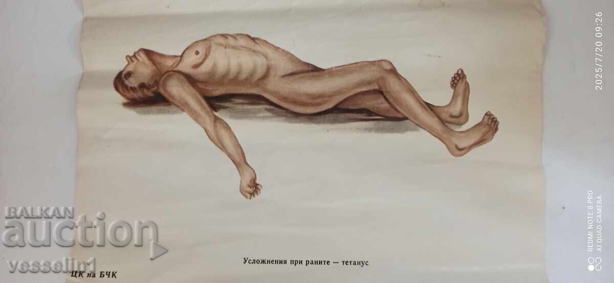 Old educational poster from the Bulgarian Red Cross - complications from wounds - with tetanus