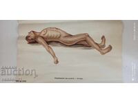 Vechi afiș didactic de la Crucea Roșie complicații ale rănilor - cu tetanos