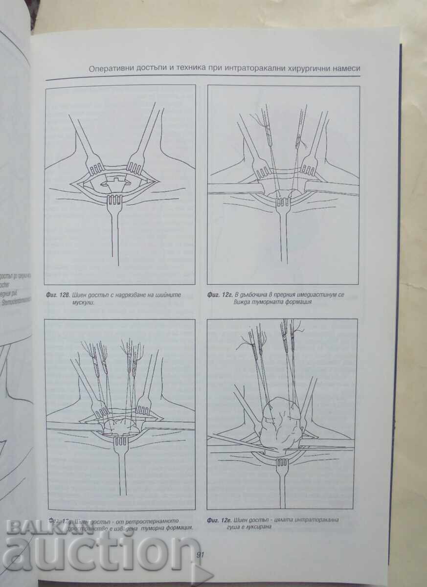 Delivery of Thoracic Surgery - Petar Chervenyakov et al. 1997 Delivery of Thoracic Surgery - Petar Chervenyakov et al. 1997
