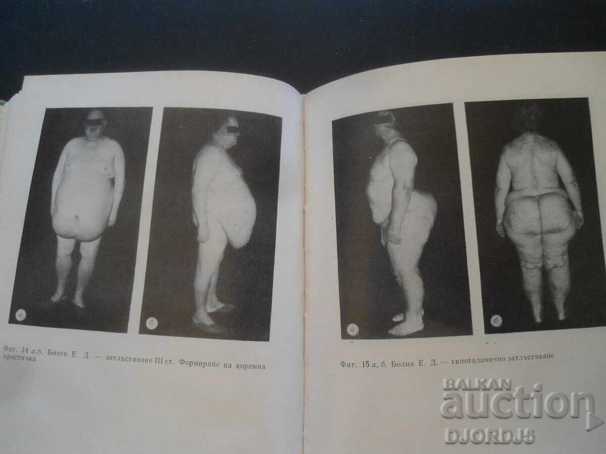 Затлъстяване, Асен Цанев - 5 Затлъстяване, Асен Цанев - 5