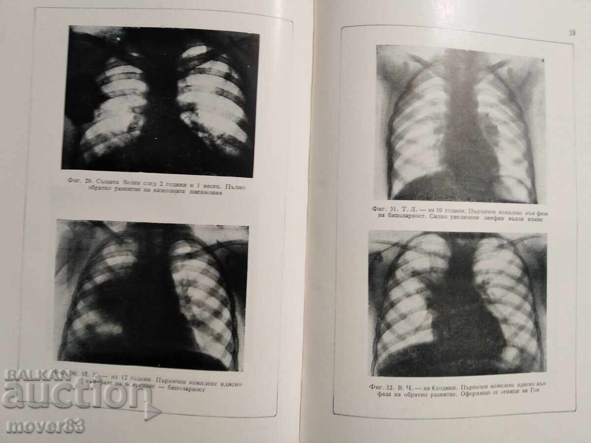 Τη φυματίωση στα παιδιά. Ράνταν Ραντάνοφ - 6 Τη φυματίωση στα παιδιά. Ράνταν Ραντάνοφ - 6