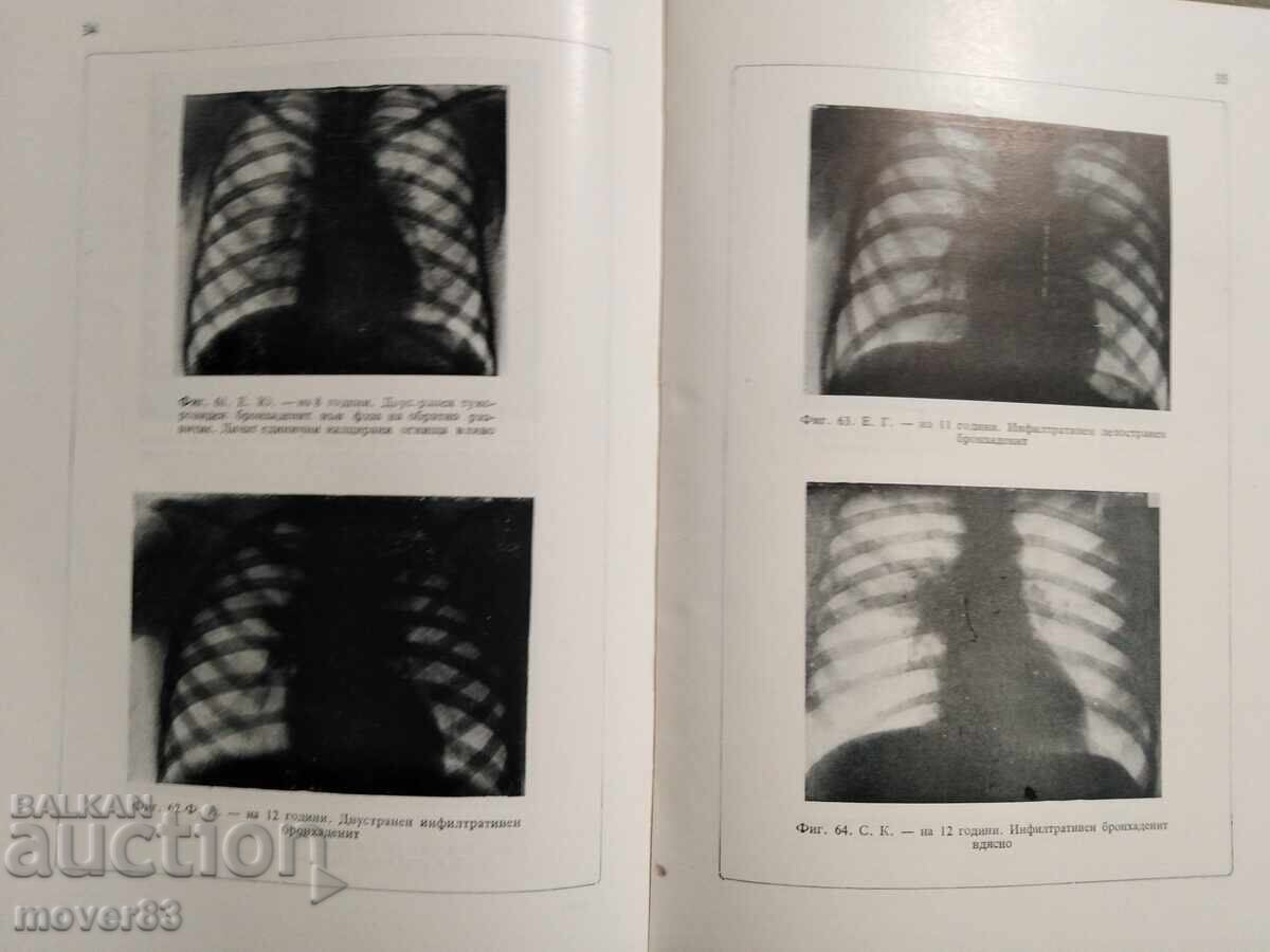 Τη φυματίωση στα παιδιά. Ράνταν Ραντάνοφ - 7 Τη φυματίωση στα παιδιά. Ράνταν Ραντάνοφ - 7
