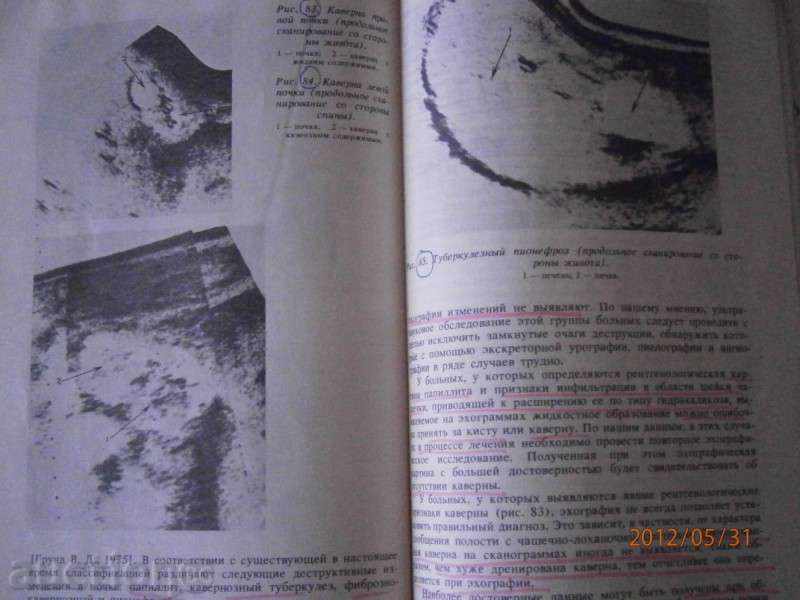 Ультразвуковая диагностика в уронефрологии - 1989 - Moscow - 5