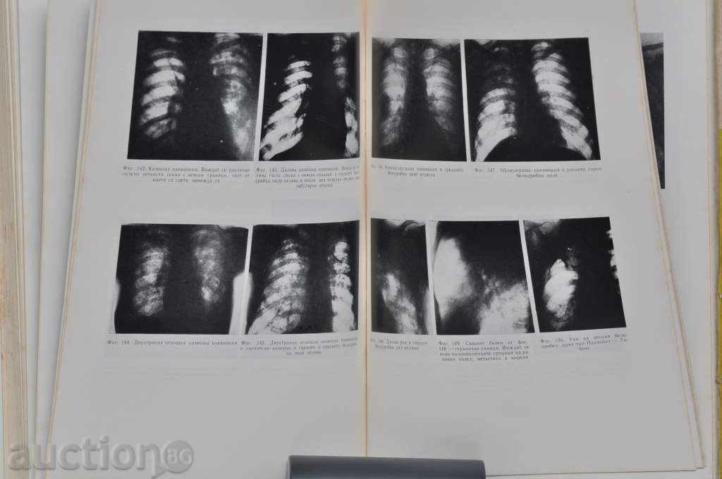 Диференциална диагностика при турбеколоза на орг. на дишане - 5 Диференциална диагностика при турбеколоза на орг. на дишане - 5