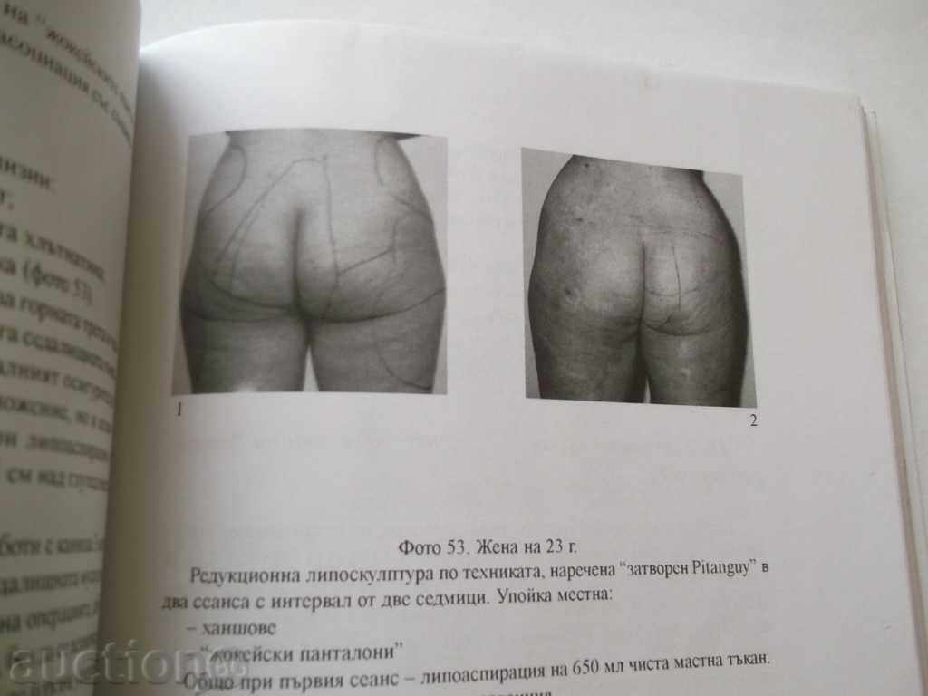 Liposuction and Surgery of Silhouette - Rumen Kazandjiev with price 25.00 BGN | € 12.78 Liposuction and Surgery of Silhouette - Rumen Kazandjiev with price 25.00 BGN | € 12.78