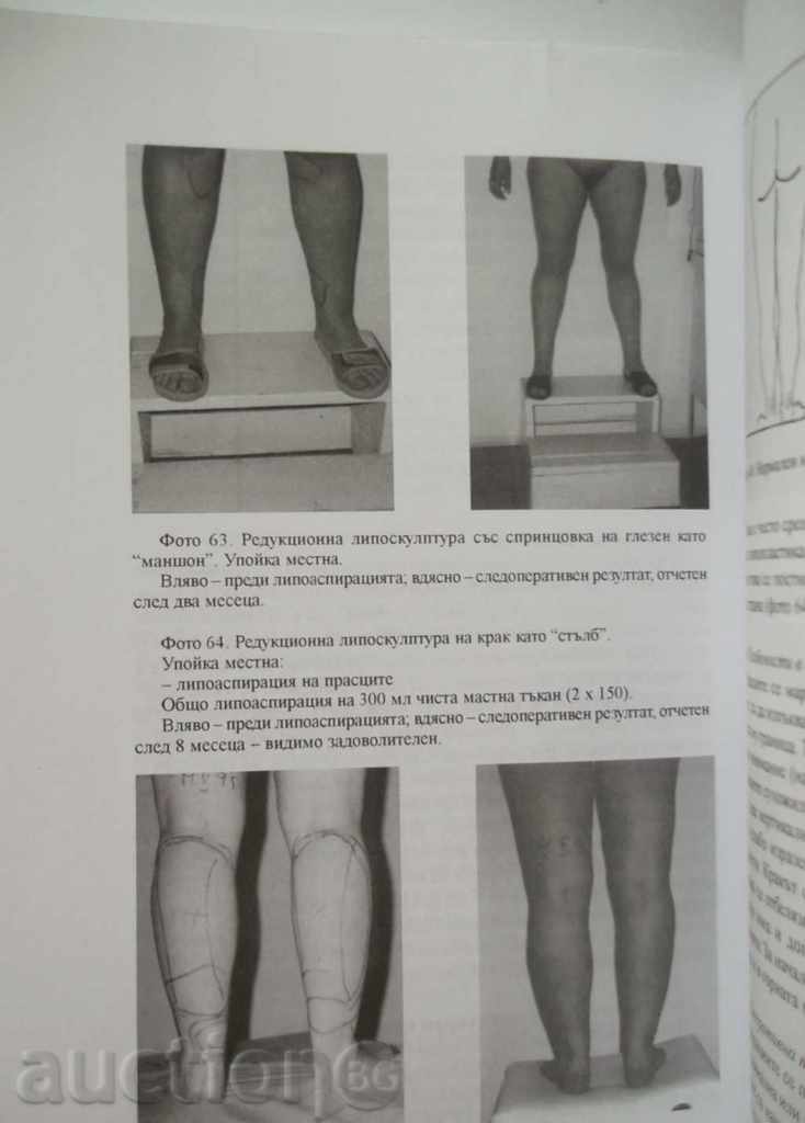 Auction Liposuction and Surgery of Silhouette - Rumen Kazandjiev Auction Liposuction and Surgery of Silhouette - Rumen Kazandjiev