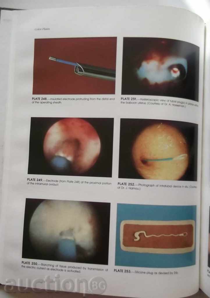 Auction Diagnostic and Operative Hysteroscopy: A Text and Atlas Auction Diagnostic and Operative Hysteroscopy: A Text and Atlas