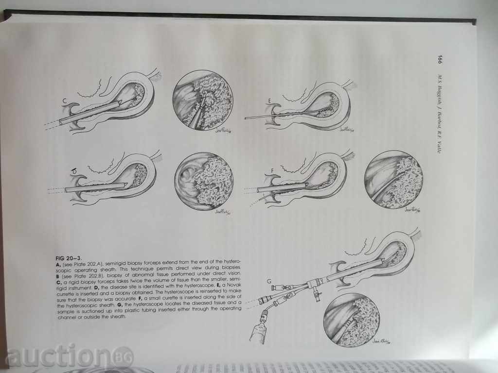 Diagnostic and Operative Hysteroscopy: A Text and Atlas - 5 Diagnostic and Operative Hysteroscopy: A Text and Atlas - 5