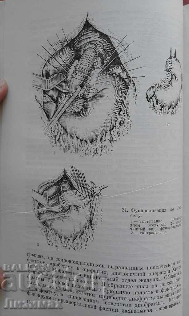 Licitație Chirurgia esofagului - Șalimov A.A., Saenko V.F