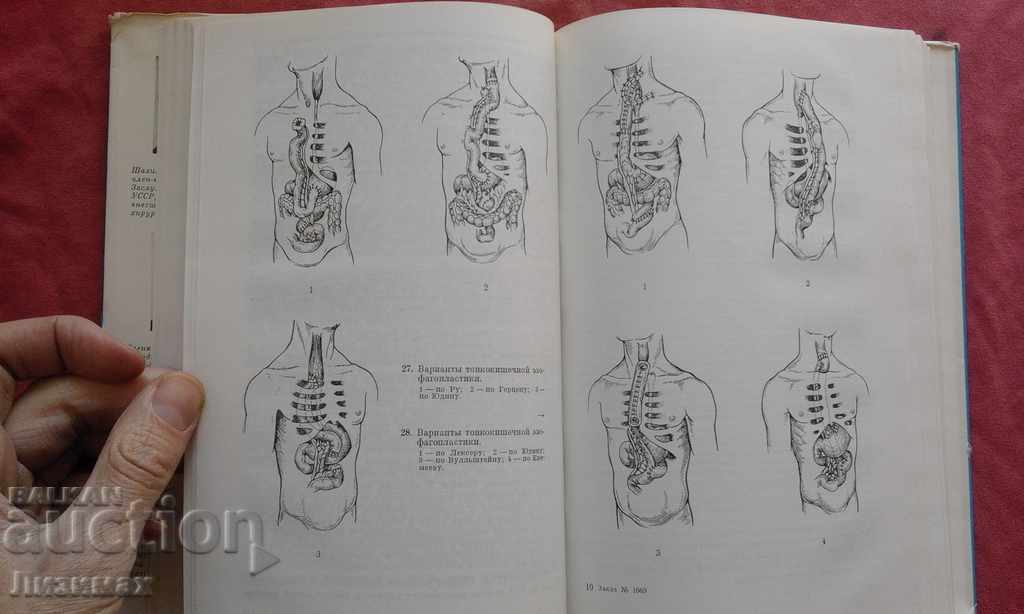 Esophageal surgery - AA Shalimov, VF Saenko - 6 Esophageal surgery - AA Shalimov, VF Saenko - 6