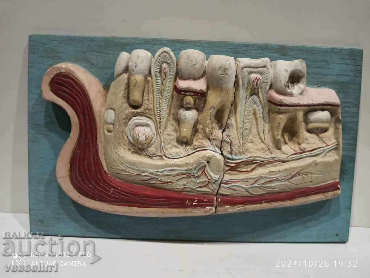 Old medical plaster model of jaw from 19th century model teeth