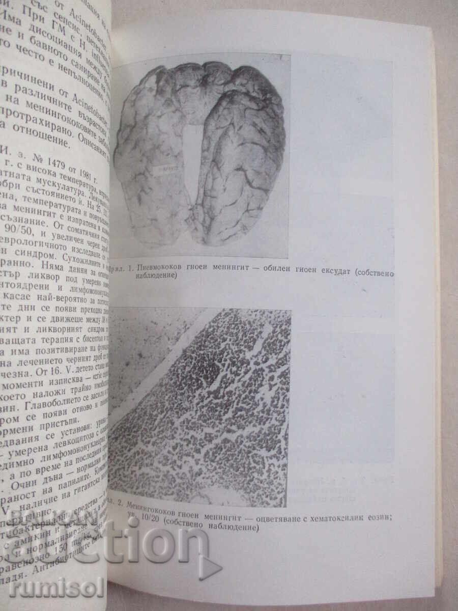 Purulent meningitis - Zhivka Kaneva - 5 Purulent meningitis - Zhivka Kaneva - 5