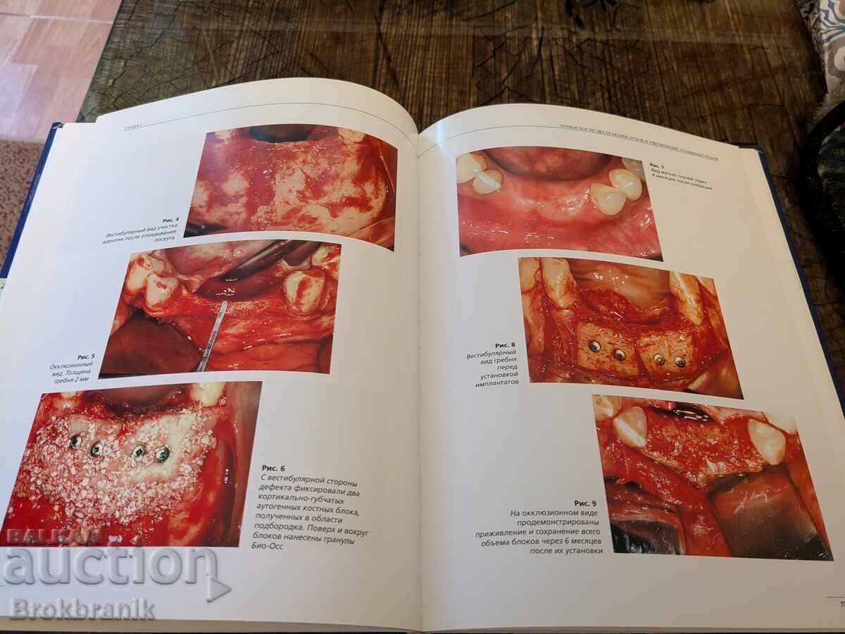 Доставка на Передовые методики регенерации кости с БИО-ОСС и БИО-ГАЙД